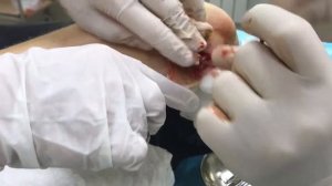 ПИОГЕННАЯ ГРАНУЛЕМА | НАЛОЖЕНИЕ ШВОВ