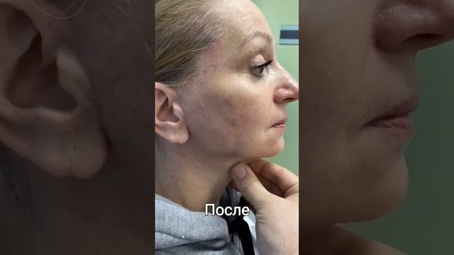 Подтяжка лица и шеи смотреть онлайн