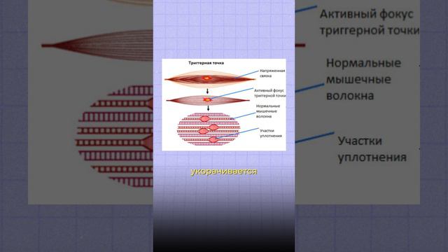 Как убрать выпирающий живот? Правда о подвздошно-поясничной мышце  
#остеохондроз #похудение #фитнес