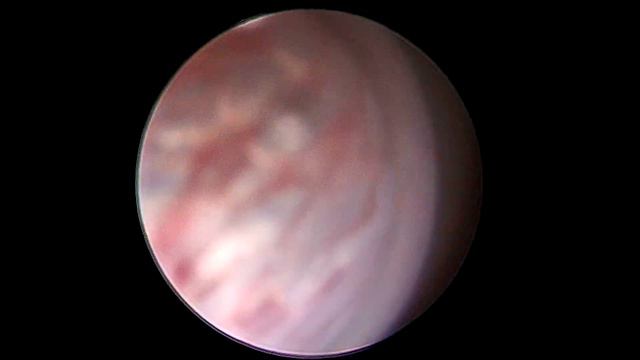 Клапан уретры смотреть онлайн