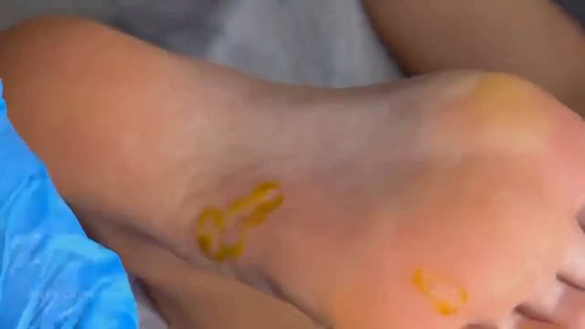 Бородавки на ноге Бородавки что это Удаление бородавок дома как убрать бородавку смотреть онлайн