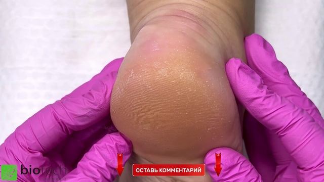 АППАРАТНЫЙ ПЕДИКЮР ДИСКАМИ MAGIC DISCS. УДАЛЕНИЕ КЕРАТОЗА.