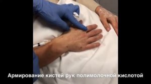 Омоложение рук препаратами полимолочной кислоты