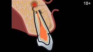Удаление сломанных инструментов из канала зуба с помощью микроскопа
