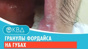 ? Гранулы Фордайса на губах. Клинический случай №329