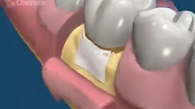 Направленная регенерация (Обучающее видео для стоматологов)