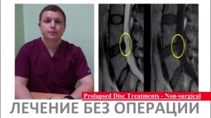 Успех  Реабилитации ЛЕЧЕНИЕ БЕЗ ОПЕРАЦИИ протрузии Prolapsed Disc Treatments - Non-surgical