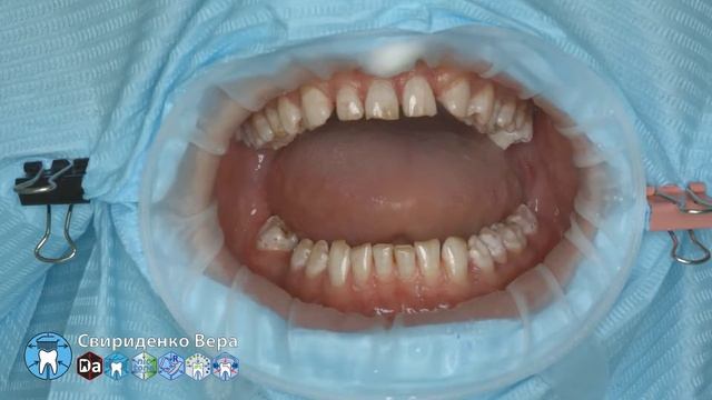 Professional oral hygiene -case 007 Acteon DTE Dentsply Coxo Floweis 3M KerrHawe (FHD multistream)