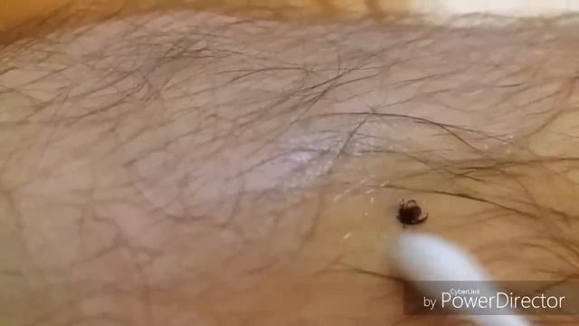 Как вытащить клеща! Как быстро вытащить клеща из тела человека|How to pull the tick! смотреть онлайн