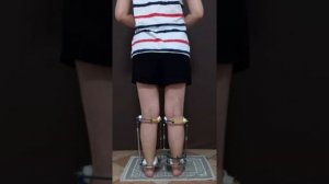 Исправление кривых ног