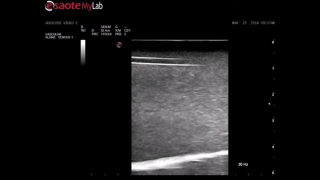 Advanced Sclerotherapy Ultrasound Training Model
