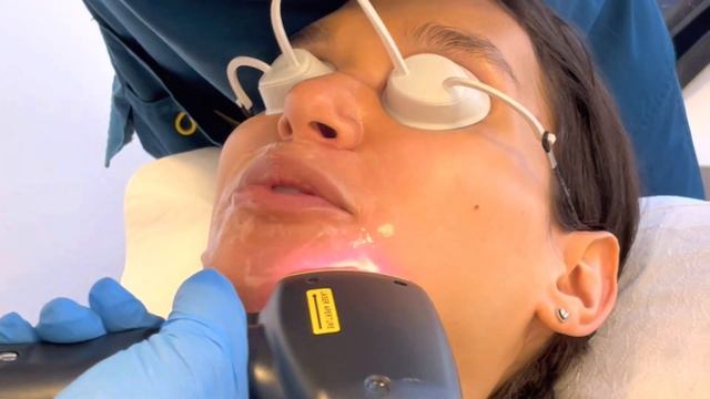 Depilación láser vello facial Helenia Melan смотреть онлайн