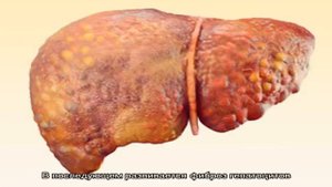 Фиброз печени 1 степени