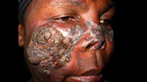 Лепрозории и прокажённые люди