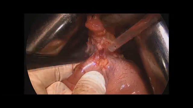 Проксимальная резекция  желудка. ЗГМУ.