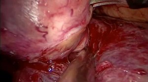 Ретроперитонеоскопическая резекция правой почки. Адреналэктомия справа. Холецистэктомия.