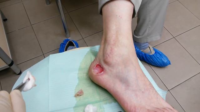 Обработка ожога 2 степени смотреть онлайн