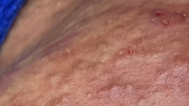 Acne Treatment For "Hung" (P7) | Điều Trị Mụn Cho Hùng (P7) -  SacDepSpa#202