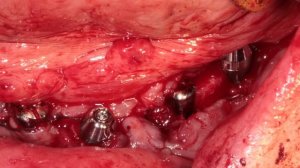 Тотальная имплантация.