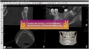 Возможности программы Ez3D: трассировка нижнечелюстного канала