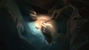 Лазер DEKA SmartLipo при хирургическом лечении гинекомастии