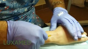 Омоложение кистей рук филлером Facetem