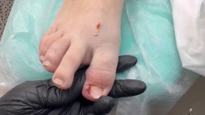 Вросший ноготь / Ноготь после удаления у подолога / Врос ноготь у ребенка, что делать? #вросший