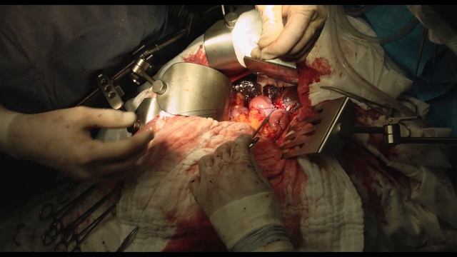 Гепатикоэнтероанастомоз узловым швом. Коваленко З. смотреть онлайн