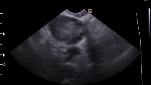 Мультифолликулярно измененные яичники на УЗИ органов малого таза (26-7-17)