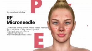 АППАРАТ МИКРОИГОЛЬЧАТОГО RF ЛИФТИНГА CHARMSTAR QUANTUS