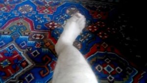 Перелом со смещением большой и малой берцовой кости