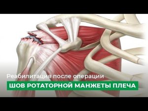 Реабилитация после операции "шов ротаторной манжеты плеча"