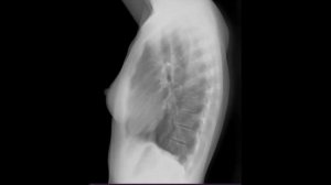 Укладка органов грудной клетки для боковой проекции