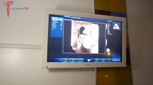 Определение многоплодной беременности по УЗИ.mp4