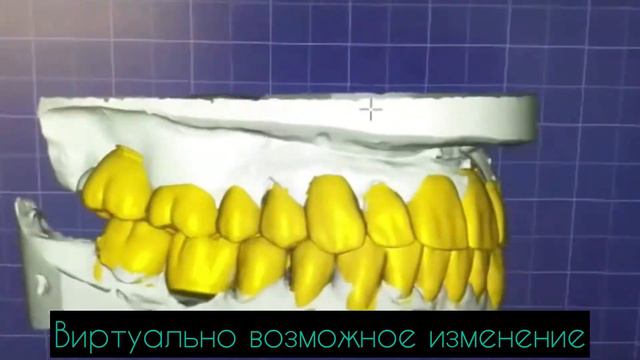Начало преображения улыбки. Как это происходит.