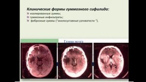 13:50  третичный и врожденный сифилис