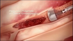 Наглядный ролик, показывающий, как удаляют тромб.