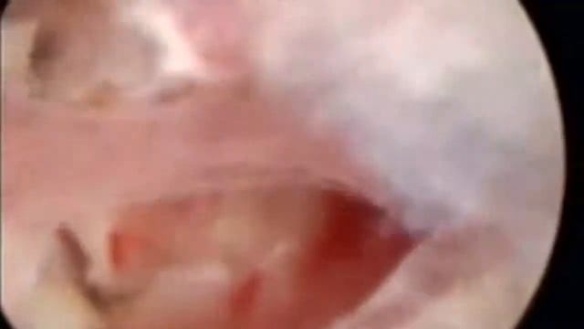 Гистерорезектоскопия с комментарием, гистероскопия, аркуатная матка, полипоз эндометрия, дистрофия