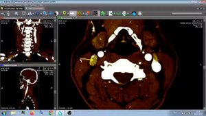 КТ АНГИОГРАФИЯ ГОЛОВА ШЕЯ .