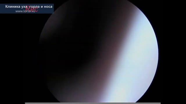 Диагностика искривления носовой перегородки смотреть онлайн