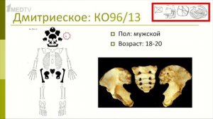 Авторская программа Марины Аствацатурян «Медицина в контексте», тема: «Палеопатология человека».