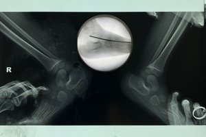 Почему нужна хирургия при вертикальном таране?