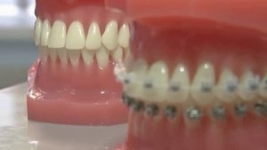 Как исправить прикус и выпрямить зубы