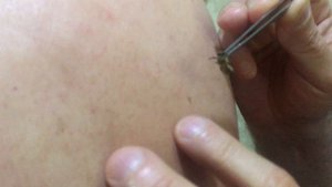 Пчелоужаливание