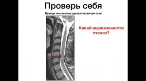 СТЕНОЗ ШЕЙНОГО ОТДЕЛА ПОЗВОНОЧНИКА. Как оценивать? какие степени? Самое важное!