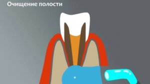Хирургическое лечение кисты зуба