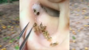 Satisfying Blackheads Removal in Ear