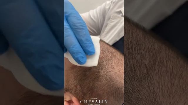 Пересадка волос. Доктор Иван Чесалин