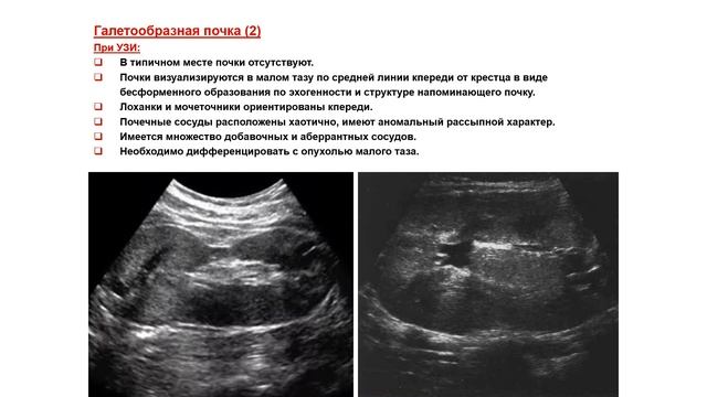 УЗИ. Доктор Иогансен. Выпуск 71. Аномалии развития почек и мочеточников. Часть 3. смотреть онлайн