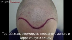 Пересадка волос, 6 Норвуд. Пересажено 7100 графтов